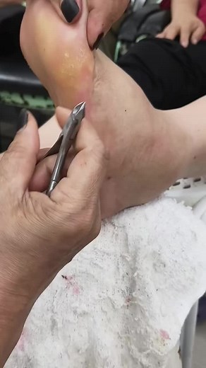 Satisfying Foot Callus & Dead Skin Removal