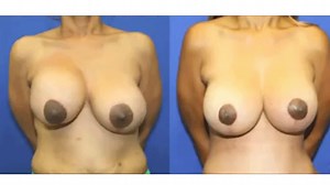 Capsulectomy, Breast Lift, and Breast Augmentation — See This Woman's Procedure (GRAPHIC)