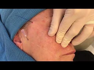 Cheek lift with PDO Threads
