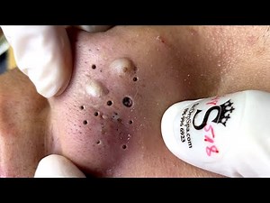 BLACKHEADS AND HIDDEN ACNE FOR THE ELDERLY|Most Satisfying Video Face Skin Care with Calm Music