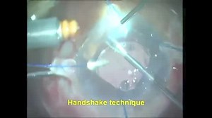 Triumvirate Technique: Modified PAL with IOL Scaffold and Glued IOL - Eyetube