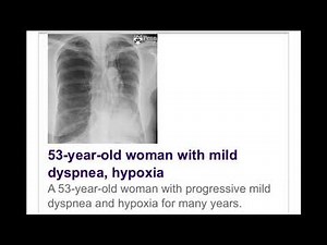 Swyer-James syndrome