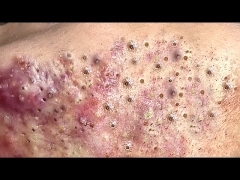 Loan Nguyen Acne Treatment #192