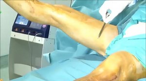 Split Thickness Skin Graft : PARAMEDIA VIDEO : Free Download, Borrow, and Streaming : Internet Archive