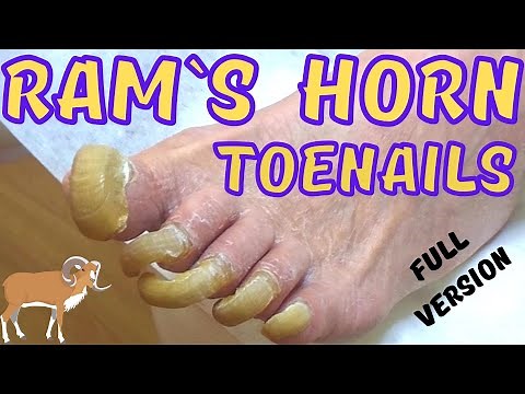 Super long toenails painless trimming. Ram`s horn toenails.