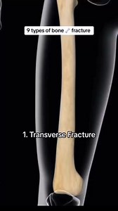 10K views · 154 reactions | Types of fracture 領. #rn #nurse #medsurg...