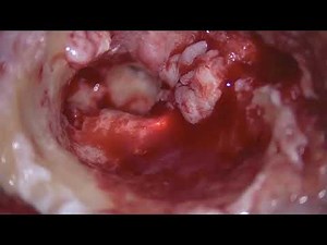 Canal Wall Down Mastoidectomy with TORP Placement and Obliterative Tympanoplasty for Cholesteatoma