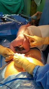 16K views · 147 reactions | Muchas felicidades Lissette y Juan por el nacimiento de su pequeño Alejandro, quien a pesar de nacer por medio de cesárea y tener una circular de cordón al cuello, se encuentra en perfecto estado de salud. ¡Bendiciones desde lo alto para los 3! #Cesarea #DulceEspera #Obstetra #Obstetricia | Dr. Oliver Ramirez | Facebook