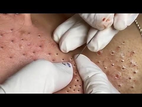 Remove Blackheads and Pimples Popping At HT Spa #25