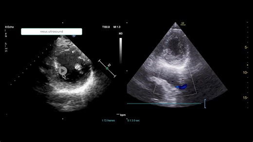 1.5K views · 18 reactions | You can see an enlarged descending aorta in both the parasternal long and short axis views. | Resuscitation&Ultrasound | Facebook