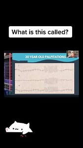 30 year old with palpitations...what is it called?變 Follow NTN for guidance, support, and mentoring 喙 Credit: @cardiologymadeeasy #NursesTeachNurses #Nurses #ICUNurse #HealthcareWorkers #NurseLife | TeachRN | Facebook
