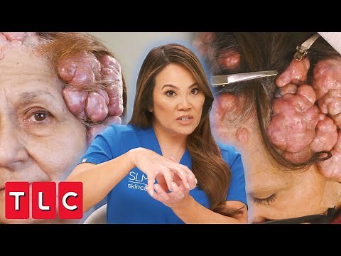 Dr. Lee Removes Gigantic Cauliflower-Like Bumps on Patient's Head | Dr. Pimple Popper