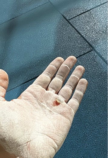 Remove Calluses Easily at Home