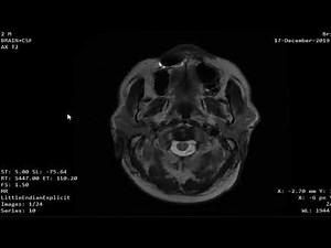 Case 1117 MRI CSF flowmetry brain atrophy