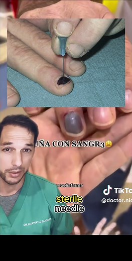 Understanding Subungual Hematoma and Its Treatment