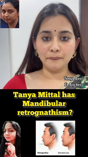 ✅What is mandibular retrognathism? It’s when your lower jaw is set too far back, making your chin look receded and your bite off. In kids, we can often guide growth using functional appliances braces. In adults, if the discrepancy is big, surgery plus orthodontics( braces/aligners) may be needed. 📍Early check up matters. Let’s give your jaw the support it needs👍 ✅Why does it happen? It often has a genetic component (jaw growth pattern) so you may see it in families. Growth of the lower jaw may