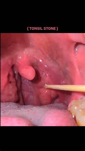 BIOLOGY | MEDICAL EXPLAINED on Instagram: "This might be hiding in your throat right now — tonsil stones. Tonsil stones (tonsilloliths) are small white or yellow deposits that form when food particles, bacteria, mucus, and dead cells get trapped in the tiny crevices of the tonsils. Over time, this material hardens and can produce a strong odor due to sulfur-producing bacteria. Common signs include persistent bad breath, a strange taste in the mouth, throat irritation, or the feeling that somethi