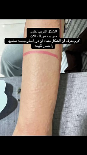 #dermatologist #filler #botox #drmaysatarek #methotherapy | Dr/ Maysa Tarek