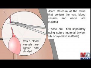 Orchidectomy