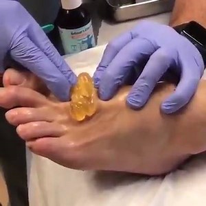 4.5K views · 25 reactions | Huge ganglion cyst popped | Pimple Popper #Fan Club | Facebook