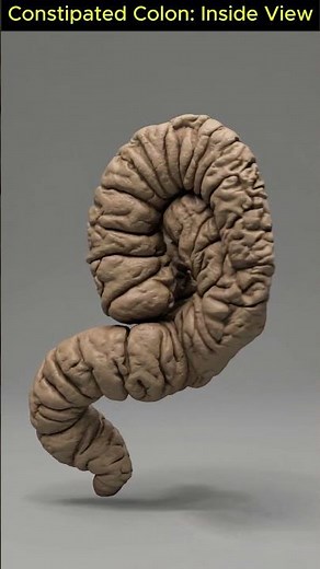 What Constipation Really Looks Like: Realistic 3D Colon Footage You’ve Never Seen | 06
