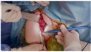 Latarjet Operation: A Step-by-Step Comprehensive Surgical Technique