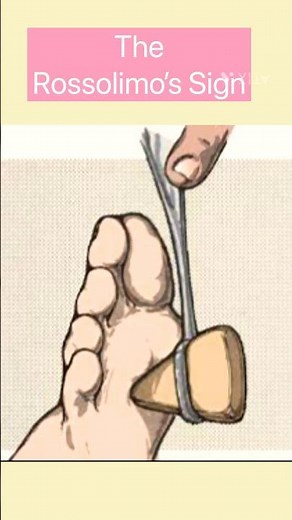 Rossolimo’s Sign #ytshorts #health #neurology