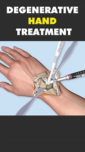 Degenerative Hand Treatment Surgery 3D Animation #handsurgery #handsurgerytoday #wristjoint #wristsurgery #wristsurgeryrecovery #medical3danimation #3dmedicalanimation | Surgery Page | Facebook