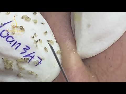 Get rid of a lot of blackheads on cheeks and forehead, chin (347) | Loan Nguyen