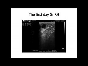 the OvSynch program in bovine reproduction