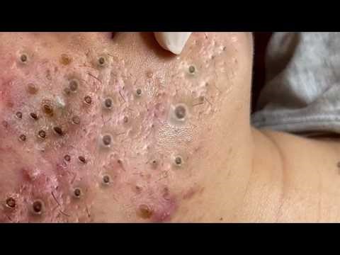 Extreme Pore Detox | Blackhead Extraction & Acne Relief