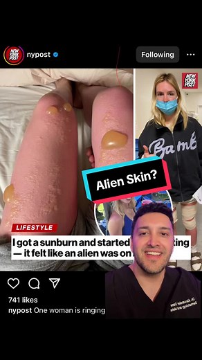 How to Treat Blisters from Severe Sunburns