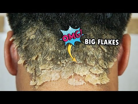 Itchy Dandruff Scratching Big Flakes Satisfying ASMR #641