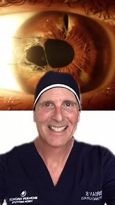 1.1K views | Fixing a giant hole in the iris (pupilloplasty) #iris #eye #coloboma #doctorsoftiktok | Dr. Brian Boxer Wachler | Facebook