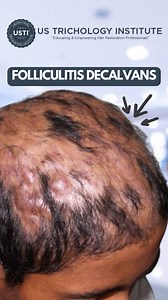 Insights and Understanding of Folliculitis Decalvans . . . #hairregrowth #hairgrowth #hairloss #haircare #hairlosssolution #thinninghair #hairlosstreatment #hair #alopecia #hairthinning #hairlossproblem #hairvolume #ayurvedichaircare #hairgrowthproducts #hairlosssolution | United States Trichology Institute