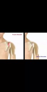 40K views · 556 reactions | frozen shoulder exercises #physio #doctor #stretching #physiotherapy #lombalgie #sport #ejercicios #HealthHack #pain #fitnesstips #viralreelschallenge #علاج #flatfeet #doctor #Stretching #علاج #ejercicios #physio #stretching # | Sami khiri physio-Dz | Facebook