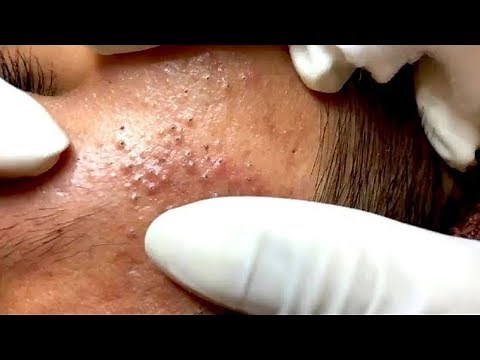 How To Remove Blackheads And Whiteheads On Face Easy #72 ✦ Dr Laelia ✦