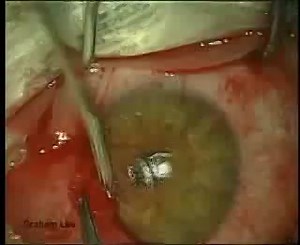 PTERYGIUM SURGERY WITH AUTO CONJUNCTIVAL GRAFT