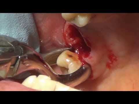 how to pull tooth