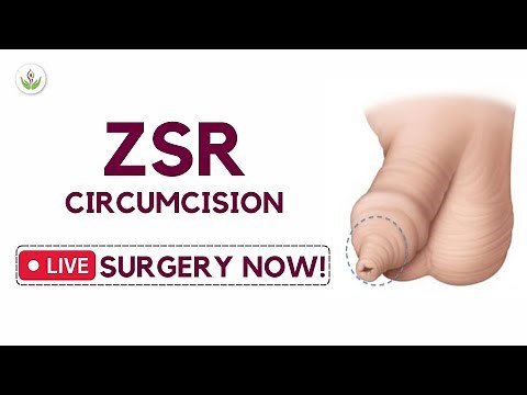 Watch ZSR Circumcision Live Surgery in Now! | How Stapler Circumcision (Phimosis Treatment) is Done?