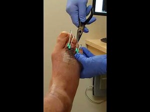Pin removal on broken toes. 5 weeks after break.