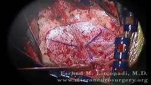 Medulloblastoma Brain Tumor Surgery