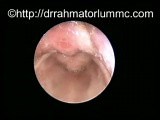 Congenital Vallecular Cyst - Endoscopic View • Video • MEDtube.net