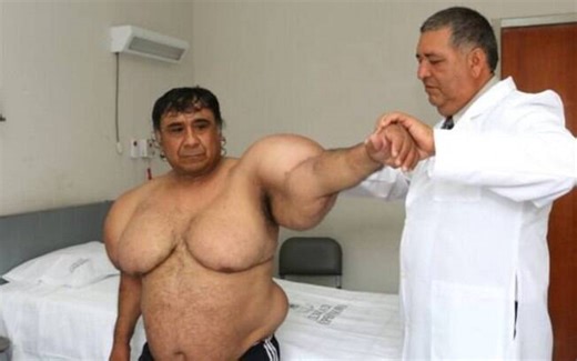 Peruvian diver’s body swelled dramatically after rapid ascent, and the condition persists a decade later