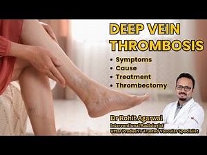 Deep Vein Thrombosis (DVT) Explained | The Silent Killer You're Ignoring! Top 7 deadly signs of DVT