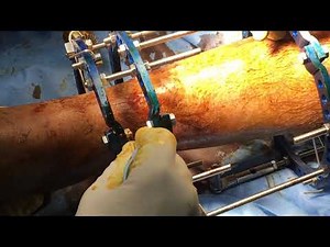 Tibia primary ilizarov