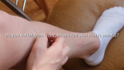 🩺✨ Itchy, scaly, red patches on your skin? It could be more than dry skin… 👀 Nearly 9 million Americans suffer from this condition but many don’t even know it. We’re uncovering the mystery behind this common condition and what new treatments are offering hope. Don’t miss this important conversation, coming up Friday on Living in the Heart of Virginia. 💬💡#SkinHealth #LivingInTheHeartOfVirginia #Dermatology #HealthAwareness | Living in the Heart of Virginia-LHOV