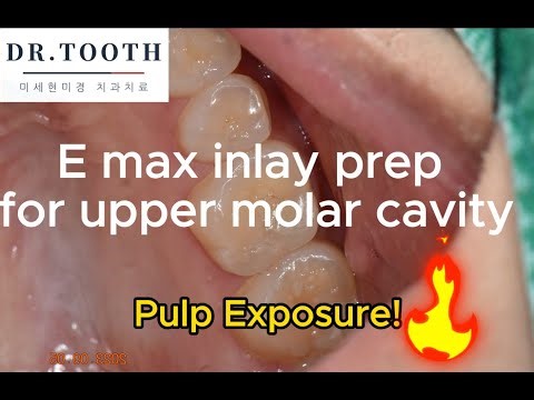 E max inlay preparation with MTA pulp capping