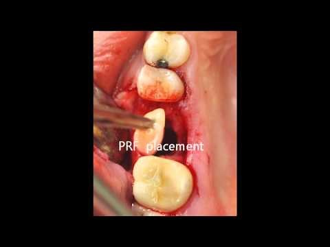 oroantral fistula closure