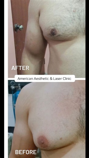 Before and after of male breast reduction mammoplasty surgery outcome. | American Aesthetic & Laser Clinic | Facebook